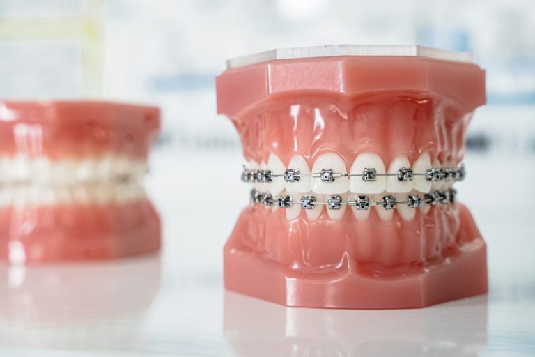 ortodoncia brackets